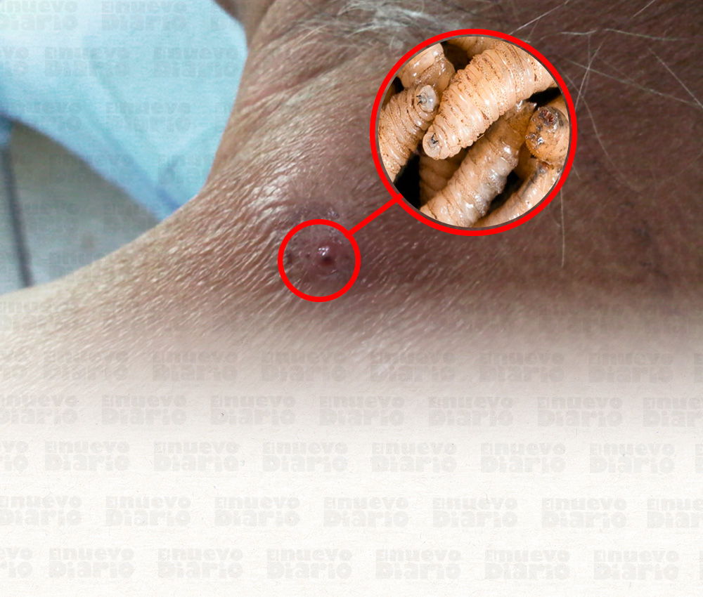 EE. UU. detecta el primer caso del gusano barrenador en humanos en su territorio