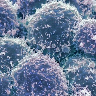 Avances en medicina abren nuevas posibilidades para el tratamiento del cáncer de pulmón Avances en medicina abren nuevas posibilidades para el tratamiento del cáncer de pulmón