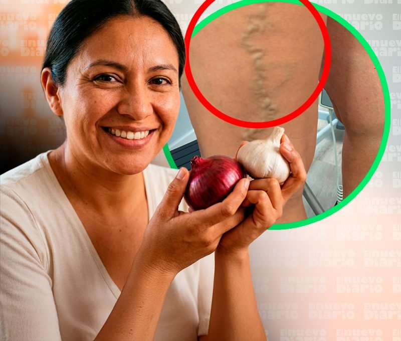 Cebolla y ajo: ayudan, previenen y alivian, pero no curan las várices, advierten especialistas