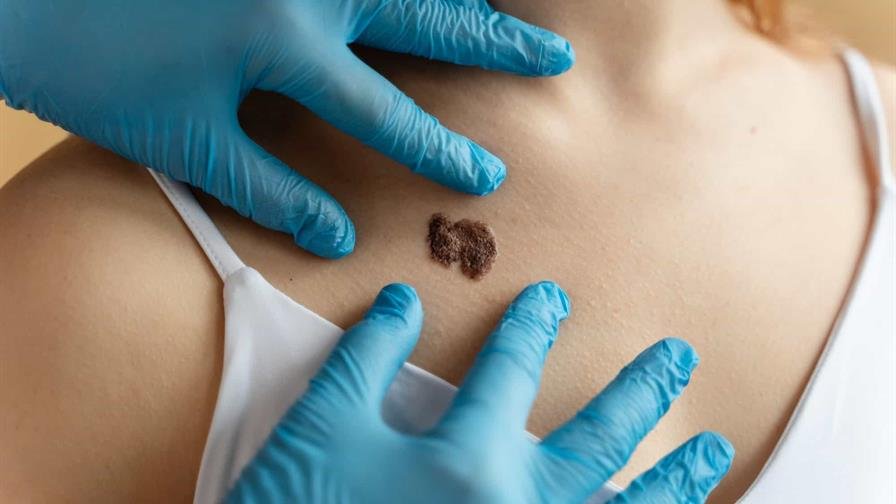 El cáncer de piel avanza en silencio en República Dominicana, alerta el Instituto Dermatológico