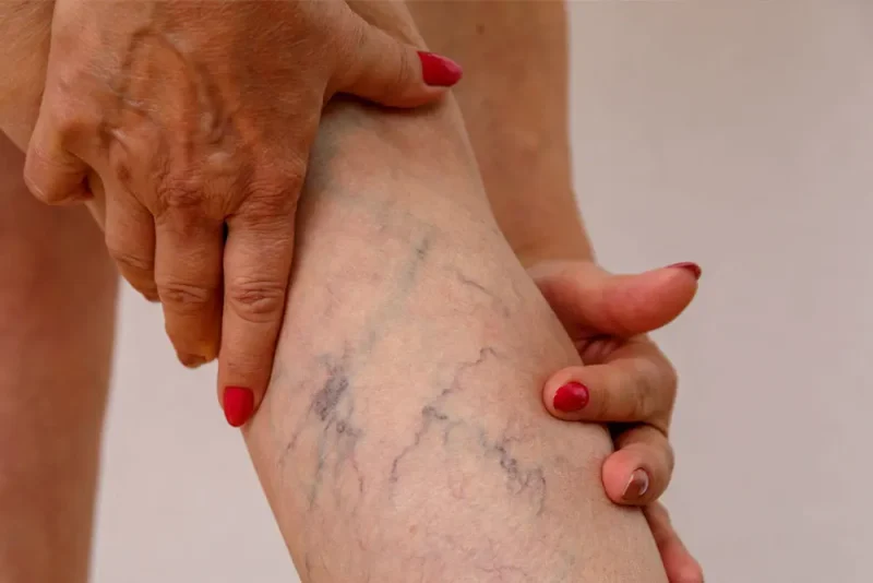 Medias de compresión, la aliada clave para combatir las várices y mejorar la circulación