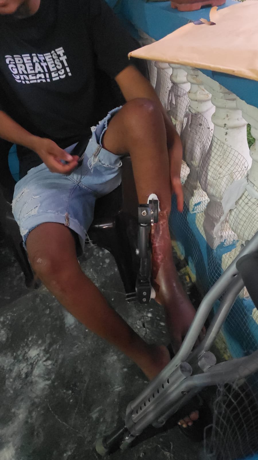 Piden ayuda a la Primera Dama para joven de 21 años que sufrió accidente en SPM