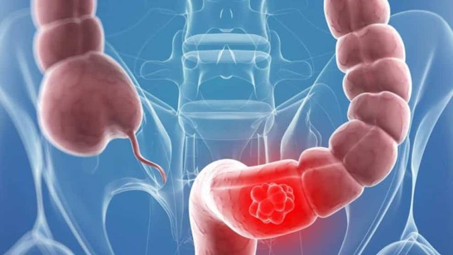 El Cáncer Colorrectal en Jóvenes: ¡No es chercha, es una vaina seria!