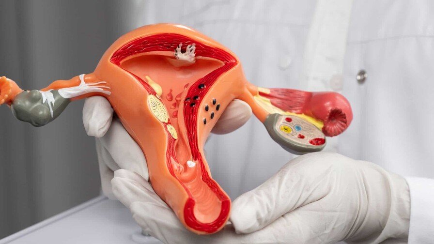 Cáncer de Cervix prevencion en Republica Dominicana