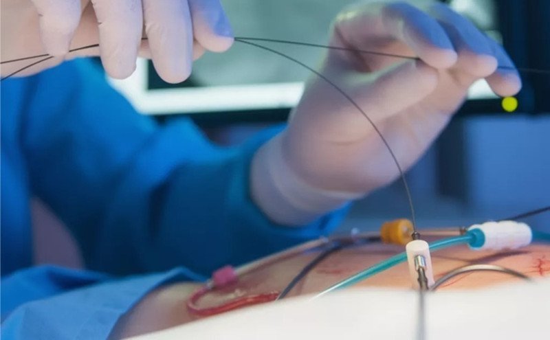 Auditoría de Angioplastias en Senasa: Transparencia Necesaria