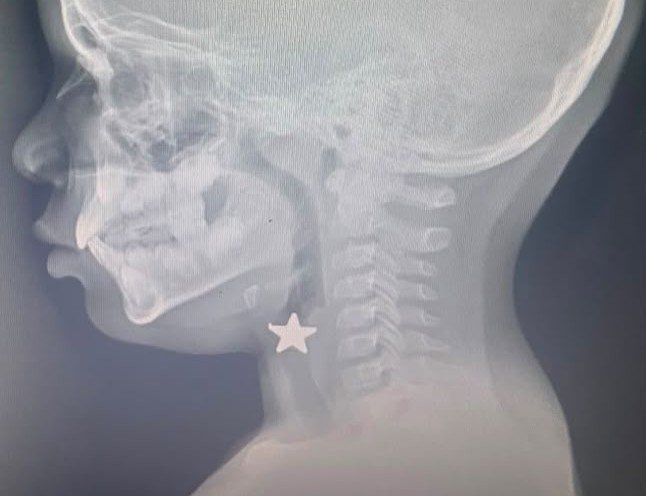 Hospital Hugo Mendoza Salva a Niño de Peligrosa Aspiración