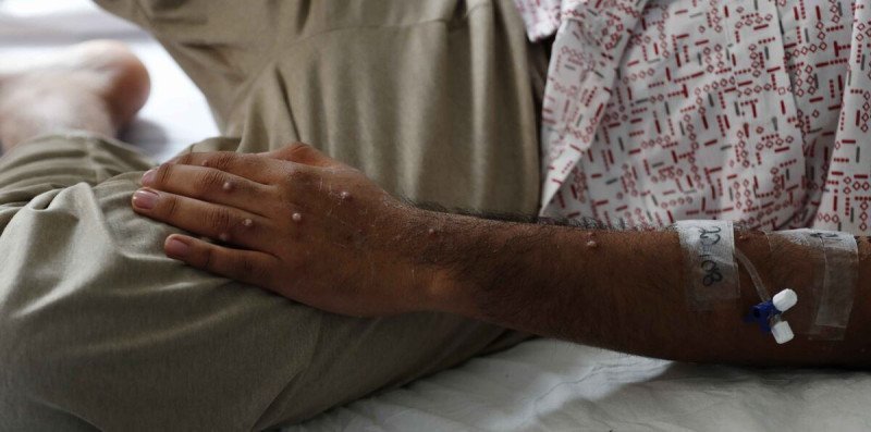 Mpox en San Cristóbal: ¡No Hay ‘Vaina’ de Transmisión Comunitaria, ‘Aseguún’ Salud! Mpox en San Cristóbal: No Hay Transmisión Comunitaria, Según Salud