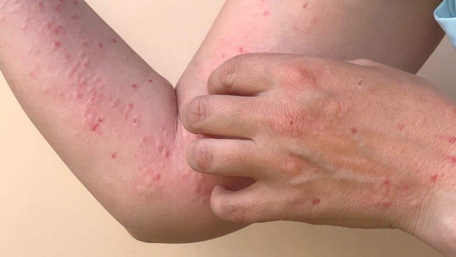 Atencion, mi gente! La vaina del Mpox se asoma en San Cristobal