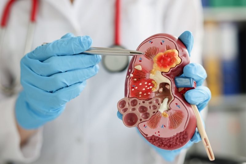 Tremenda Vaina: Avance Bacano en la lucha contra el Cáncer Renal Avanzado
